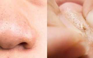 Как избавиться от черных угрей на носу