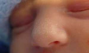 Прыщи на щеках у новорожденного