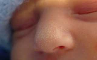 Прыщи на щеках у новорожденного